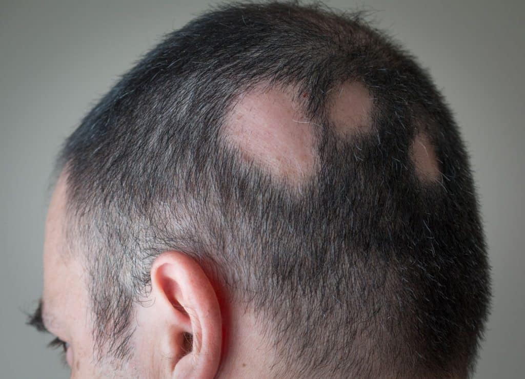 queda de cabelo